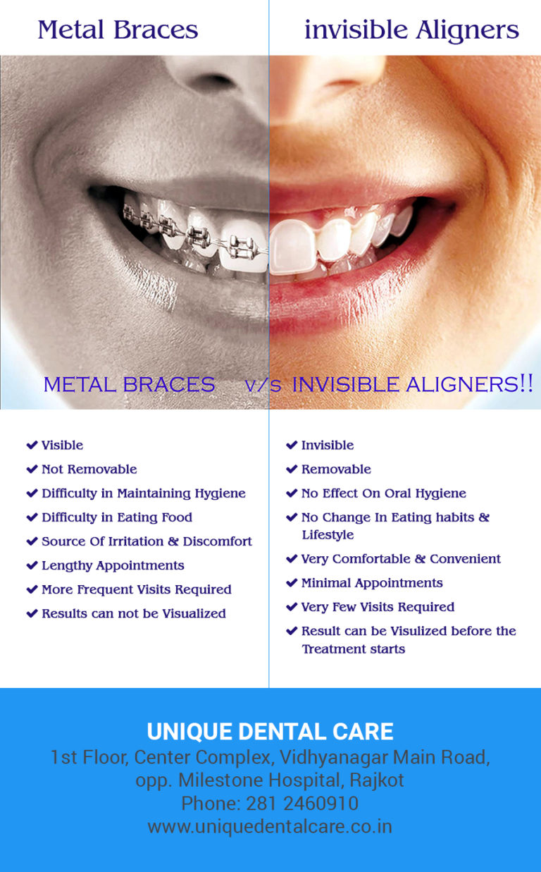 invisible aligners vs braces