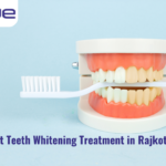Best Teeth Whitening Treatment in Rajkot, Gujarat