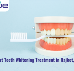 Best Teeth Whitening Treatment in Rajkot, Gujarat