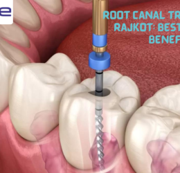 Root Canal Treatment in Rajkot: 5 Benefits You Didn't Know