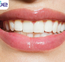 best teeth whiting treatment in rajkot