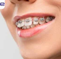 Orthodontic Treatment in rajkot