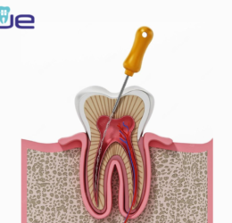 root canal treatment in Rajkot