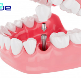 best dental implant treatment in rajkot