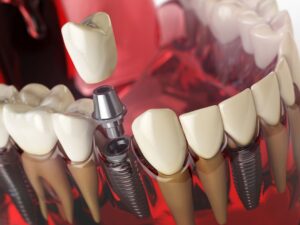 dental implant in rajkot