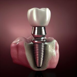 best dental implants in Rajkot