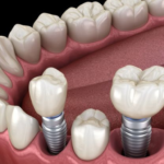best dental implants in Rajkot